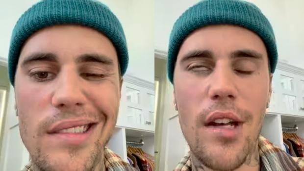 Justin Bieber reveló su diagnóstico de síndrome de Ramsay Hunt el 10 de junio a través de Instagram.